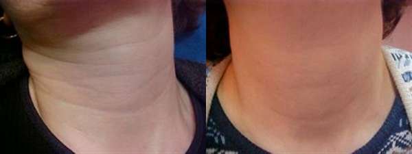 Neck Line Correction by Botox