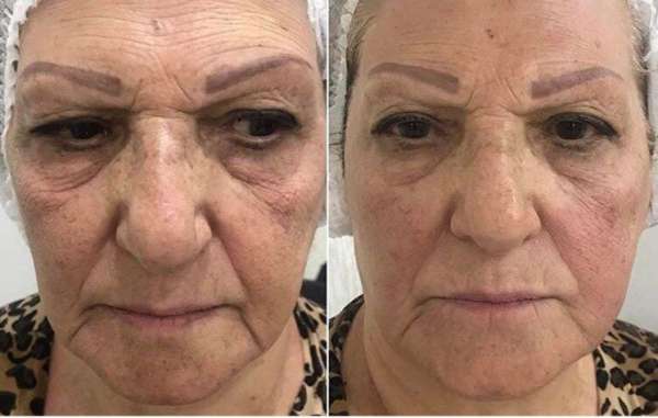تصحيح تجاعيد الوجه بواسطة HIFU العلاج