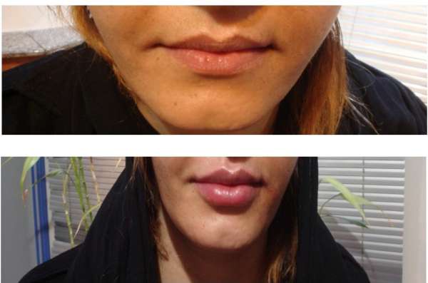 تصحيح الشفاه بواسطة فیلر