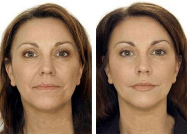 تصحيح خط ناسولابيال بواسطة فیلر