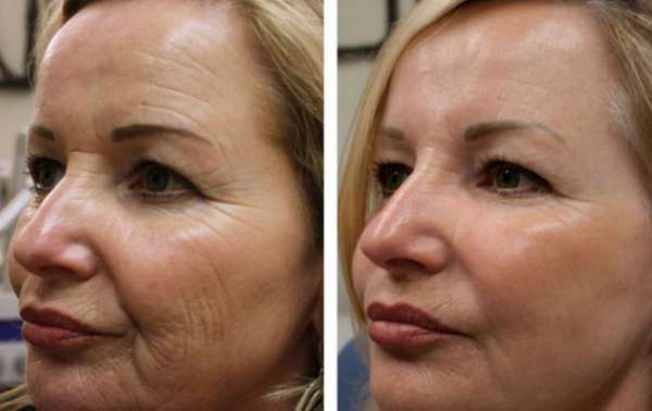 تصحيح تجاعيد الوجه بواسطة HIFU العلاج