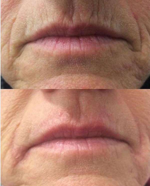 تصحيح التجاعيد الشفة بواسطة HIFU العلاج