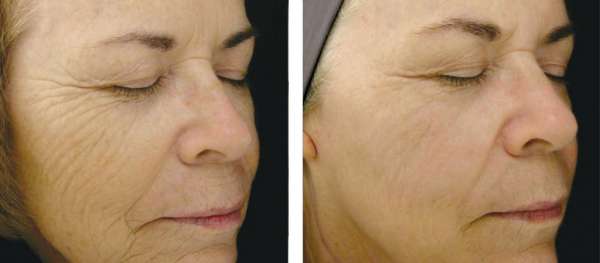 تصحيح تجاعيد الوجه بواسطة HIFU العلاج